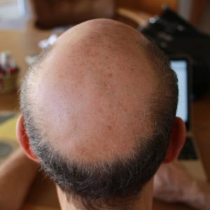 baldness t20 6lO73o