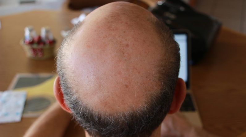 baldness t20 6lO73o